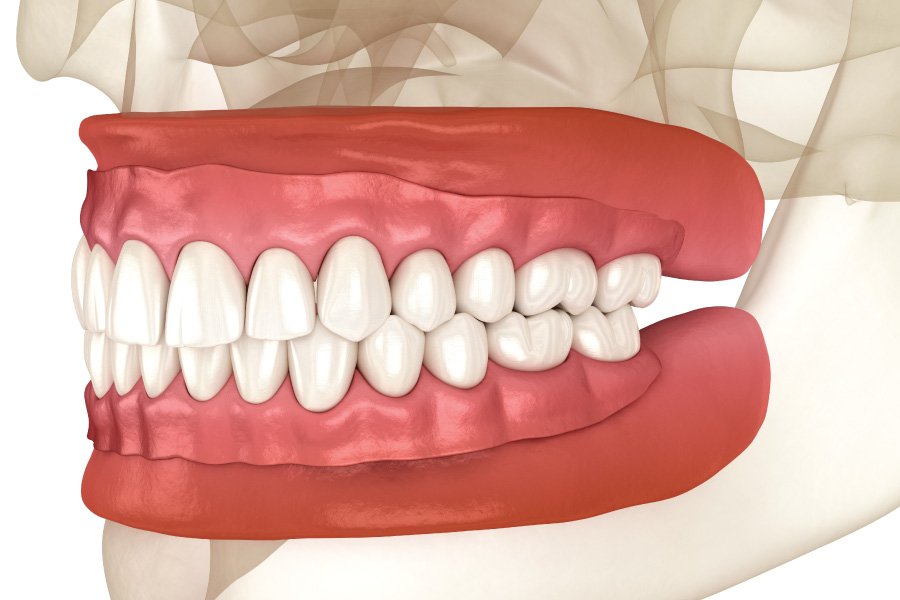 Riverside Full Dentures