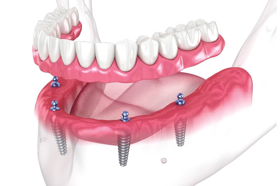 Riverside Implant-Supported Dentures