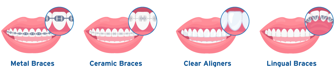 Types of Braces