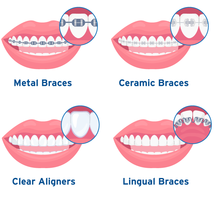 Types of Braces