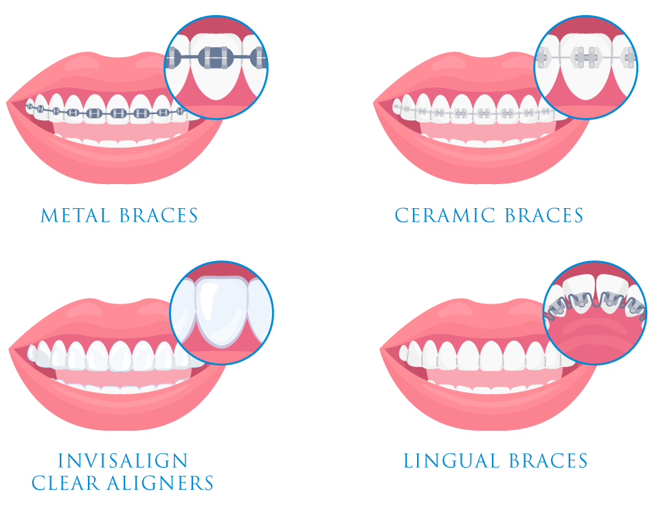 Types of Braces
